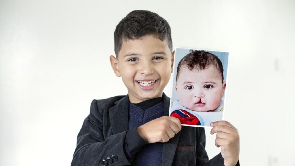 Free Surgery for Kids to Smile Brightly on Eid Al Fitr